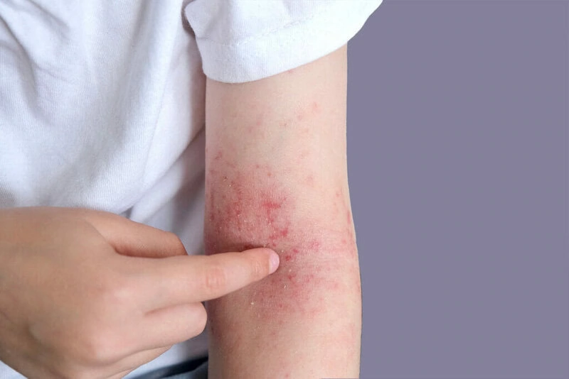 eczema-dermatite-atopica-pelle-malattie-della-pelle-ponticello