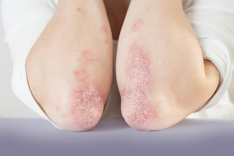psoriasi-malattie-della-pelle-ponticello