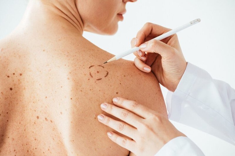 tumori-della-pelle-epiteliomi-melanoma-chirurgia