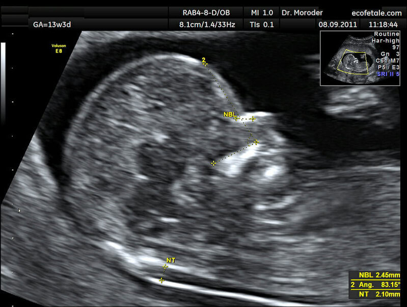 translucenza-nucale-bitest-test-combinato-diagnosi-prenatale-sindrome-di-down-ponticello