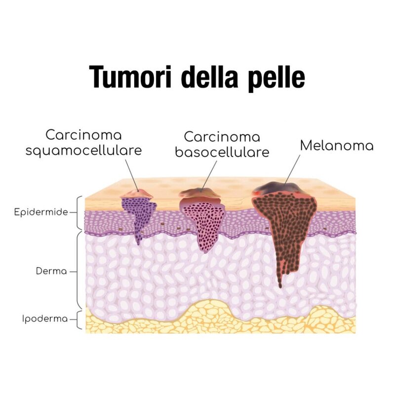 tumori-della-pelle-epiteliomi-melanoma-anatomia