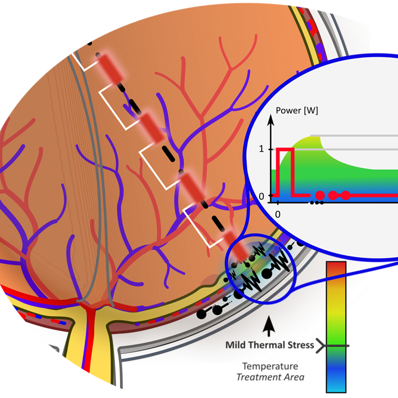 Subthreshold Pulsed Laser (SPL): localised RPE hyperthermia with temperature profile