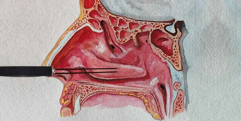 ipertrofia-dei-turbinati-risonanza-quantica-molecolare