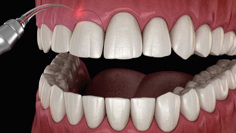 gingivectomie