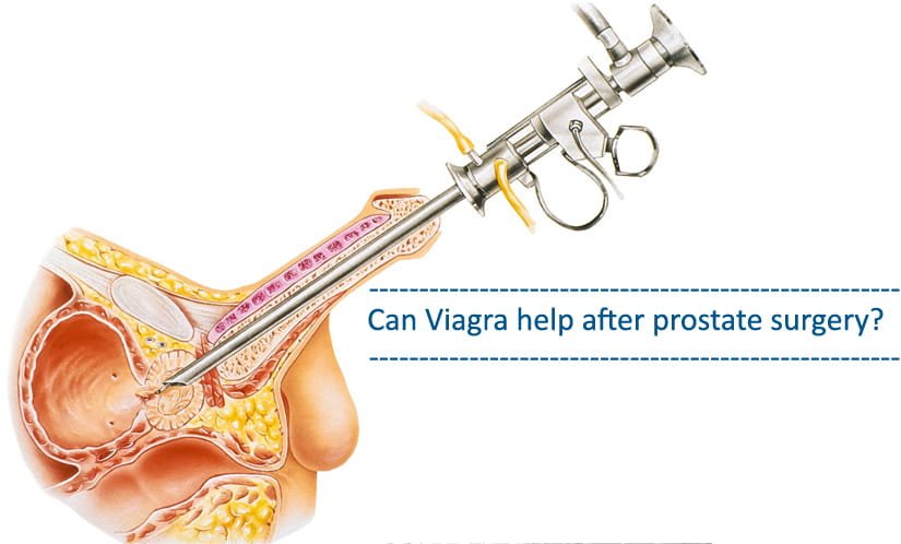 Can Viagra help after prostate surgery