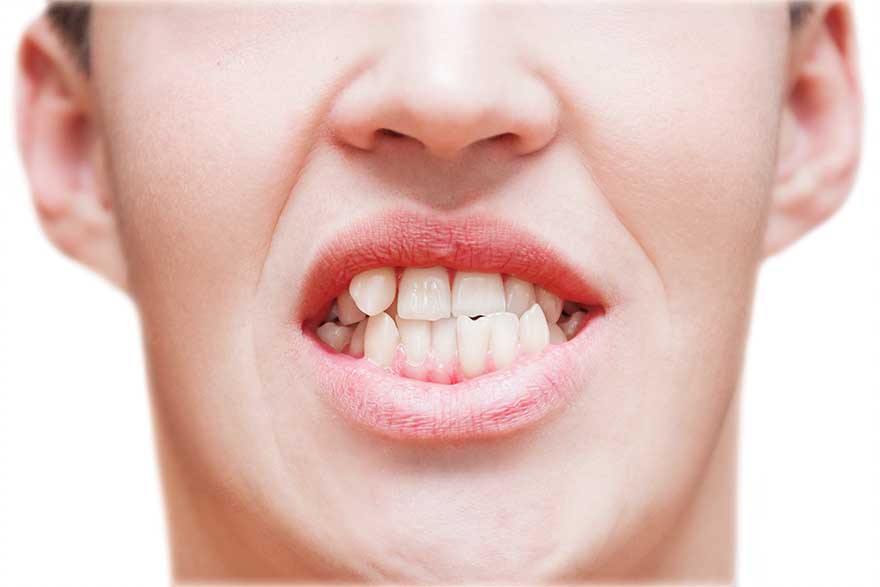 Misaligned Teeth