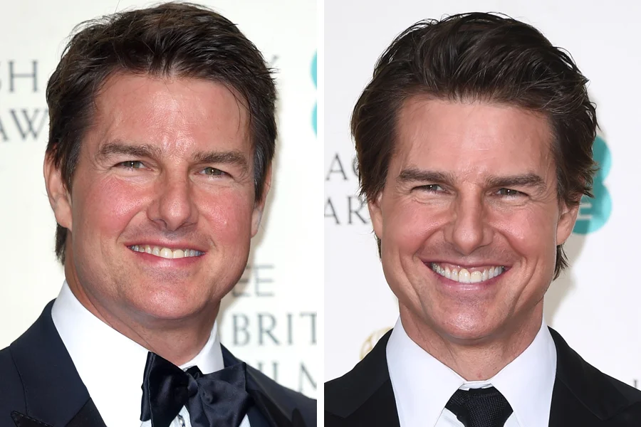 Tom Cruise Before and After Plastic Surgery
