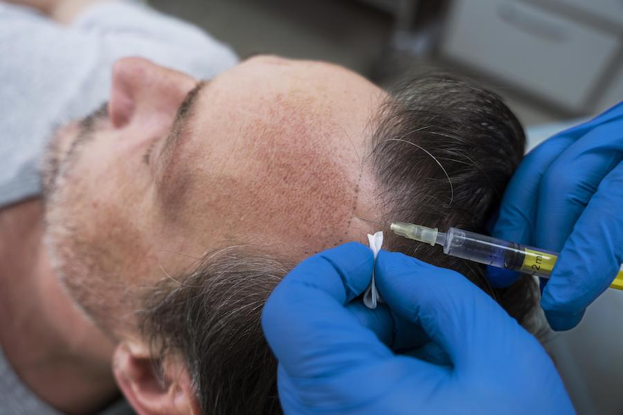 The 5 Stages of A Hair Transplant Procedure