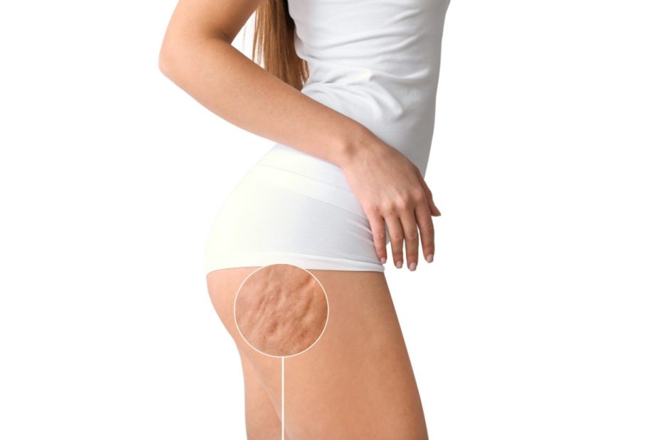 A képen egy női alsótest látható, zsírpárnák hangsúlyozásával.