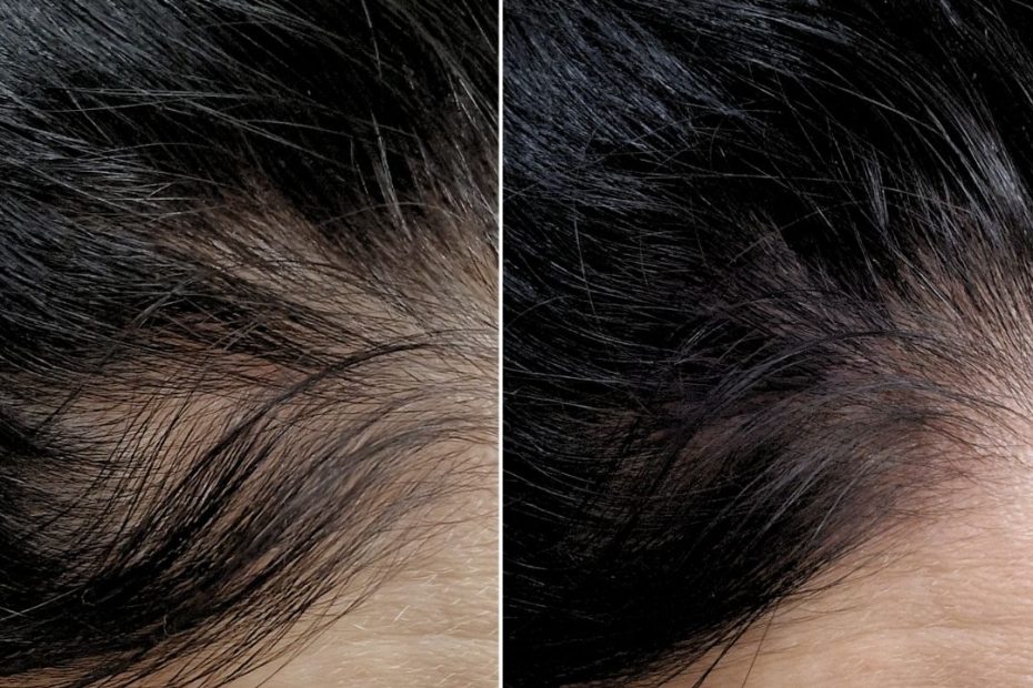 A fotó egy montázs, amelyen a lézeres hajterápia eredménye látható előtte és utána fotókon