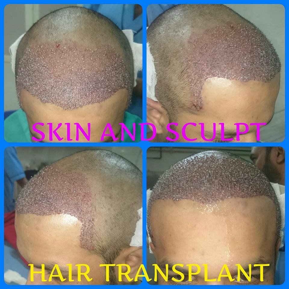 You are currently viewing HAIR TRANSPLANT
