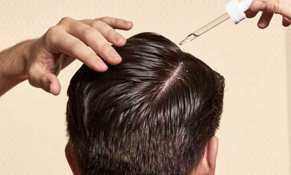استخدام المينوكسيديل للشعر
