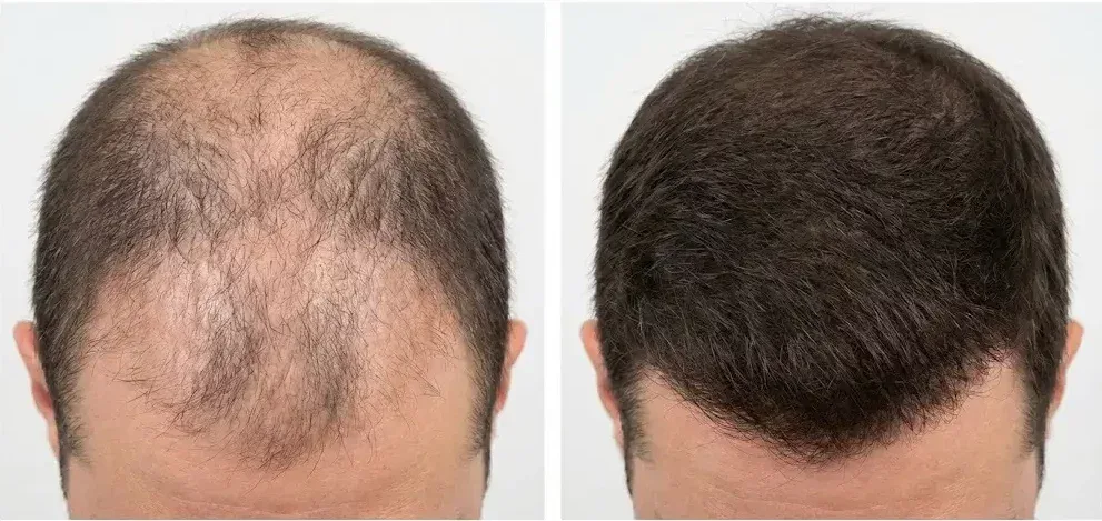 Ultra-realistic medical before-and-after image showing Ozempic-associated hair loss