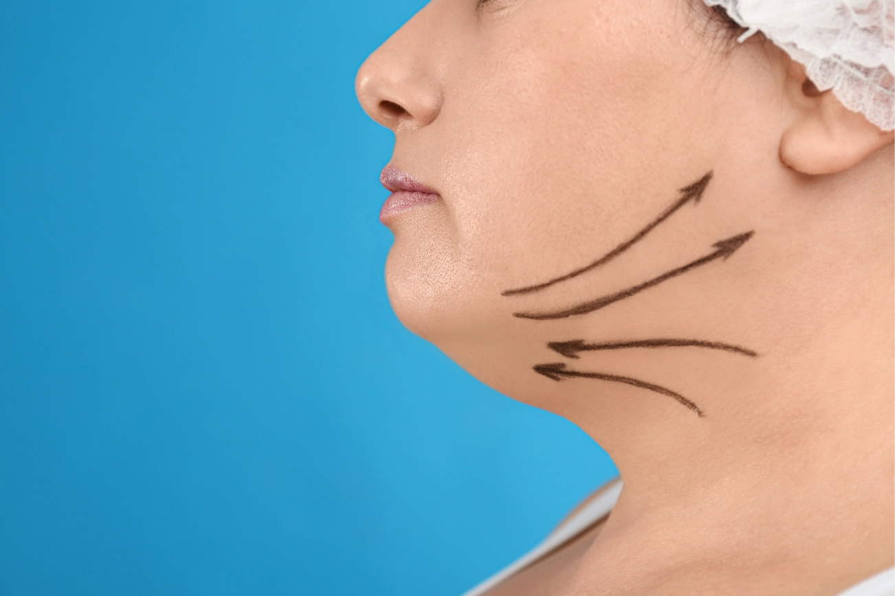 Before treatment lines drawn on woman's chin and neck to examine the area to be treated with HIFU and Morpheus8