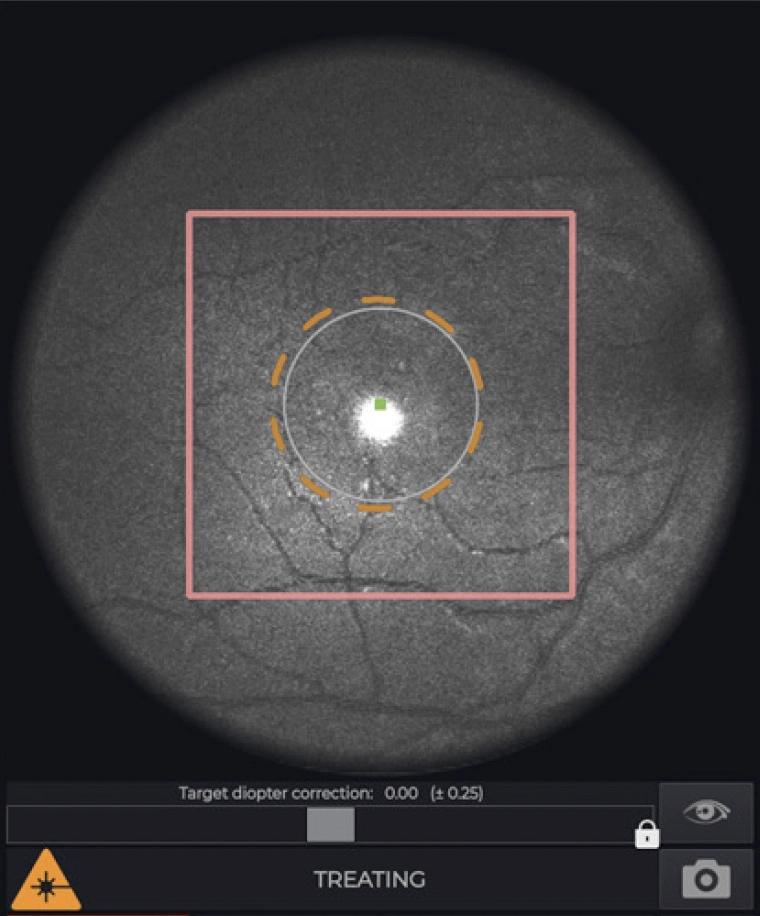 retinaSEES console showing alignment and treatment view