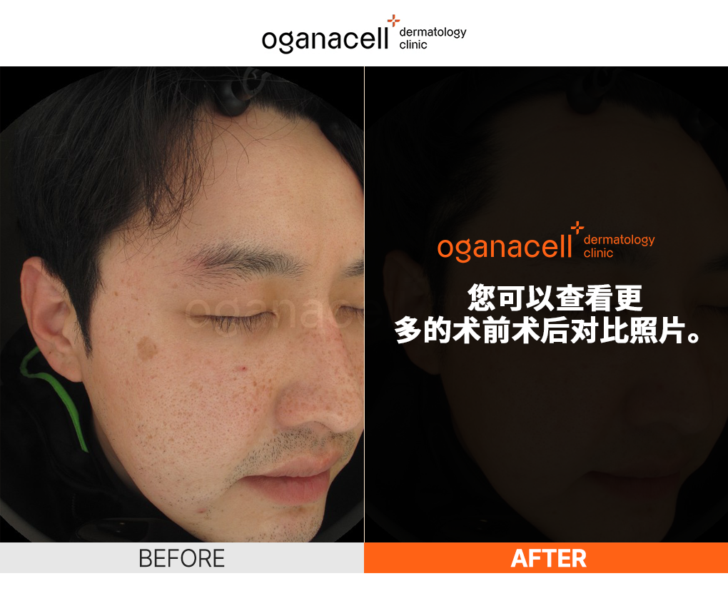 皮肤科皮肤管理前后对比图片
