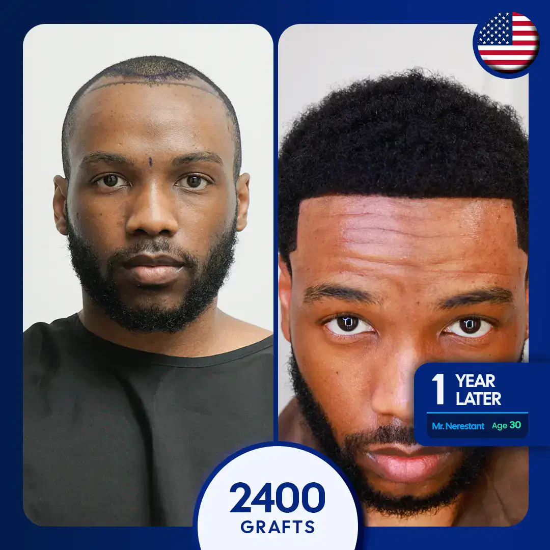 Afro hair transplant before and after at vera clinic