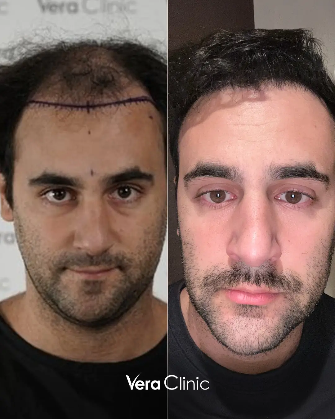 a fuller look after FUE hair transplant