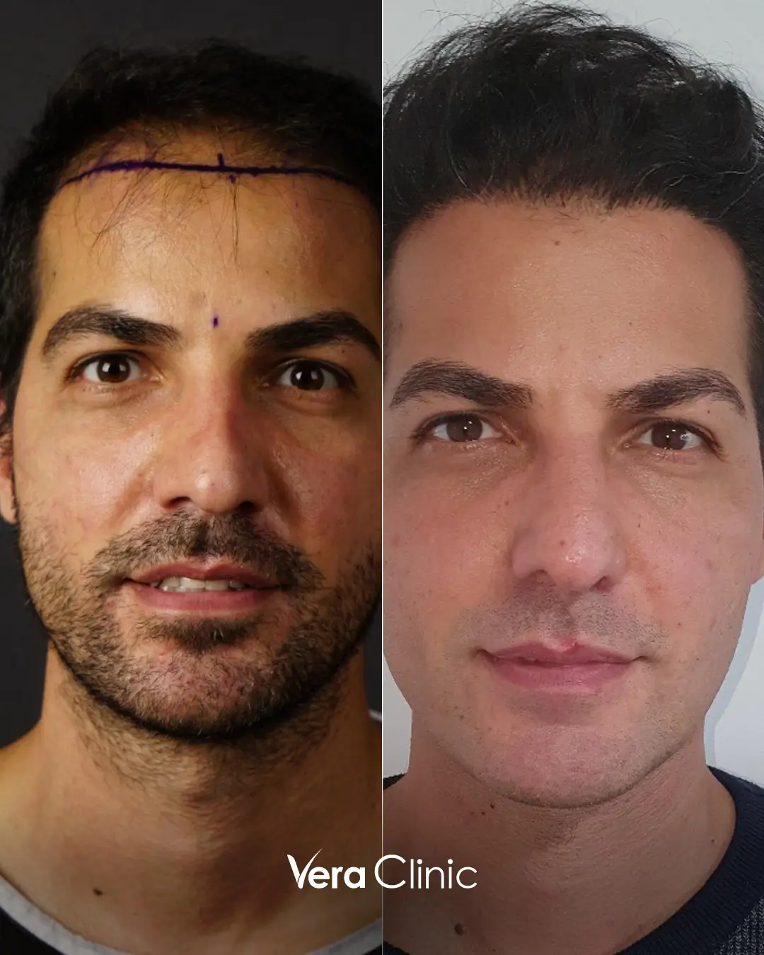 blonde, natural FUE hair transplant results for male hair loss