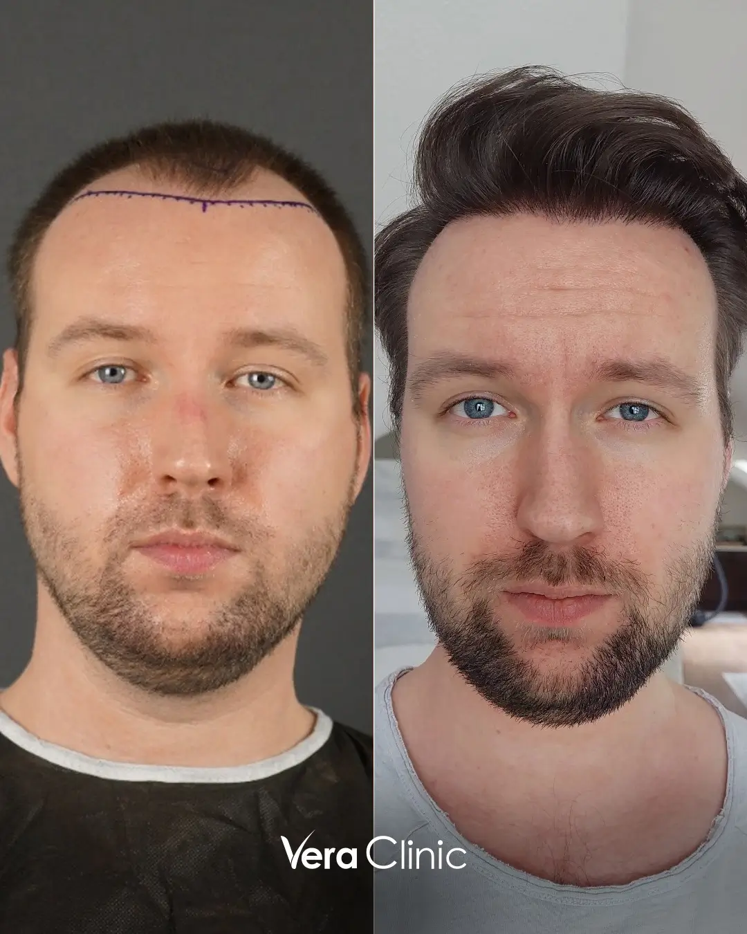 natural FUE hair transplant results