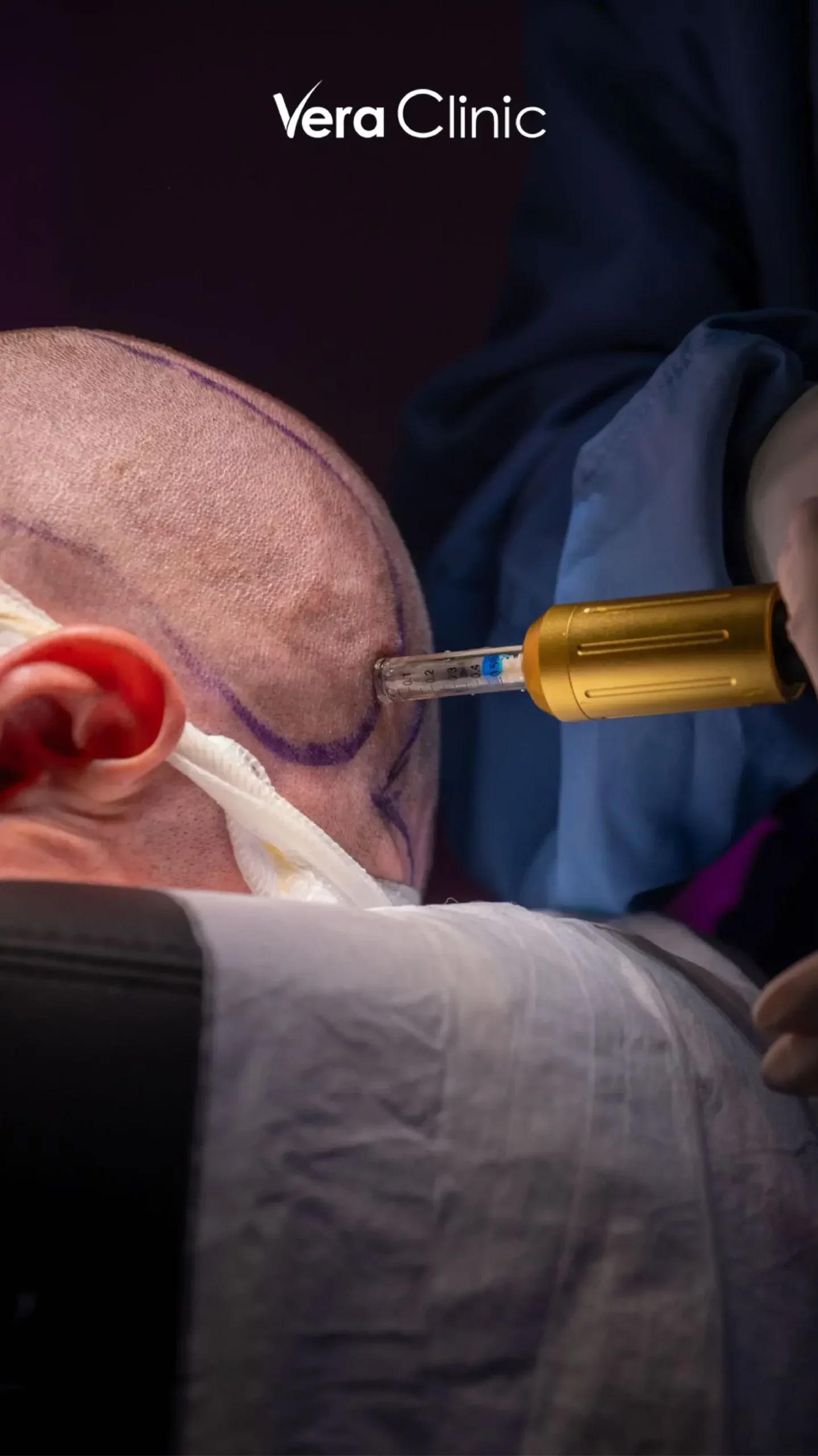 local anesthesia for hair transplant