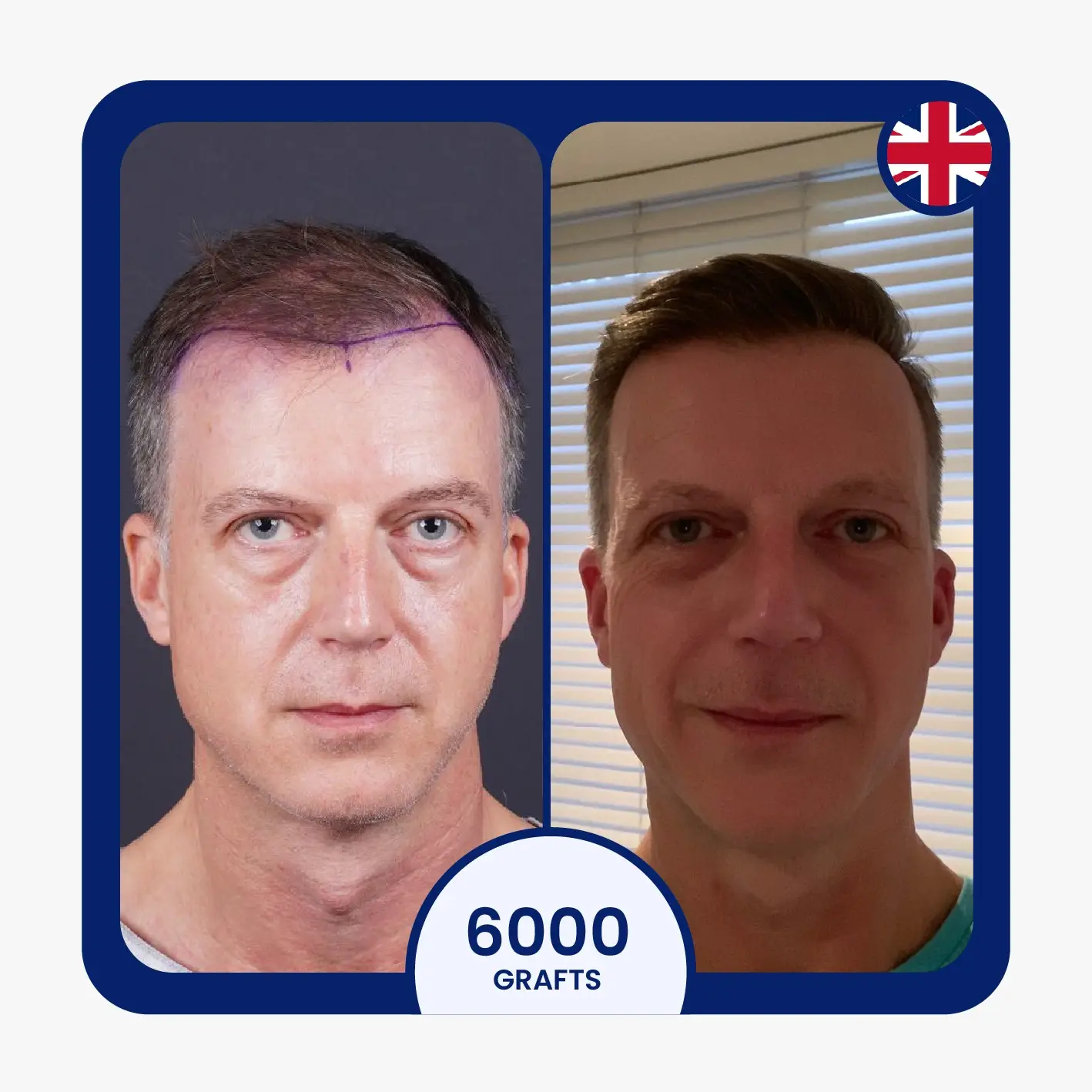 Sapphire FUE hair transplant before after for 6000 grafts