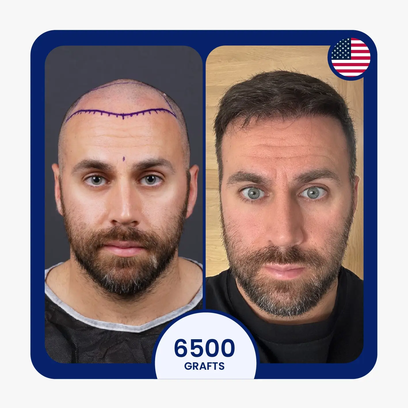 Sapphire FUE hair transplant before after for 6500 grafts