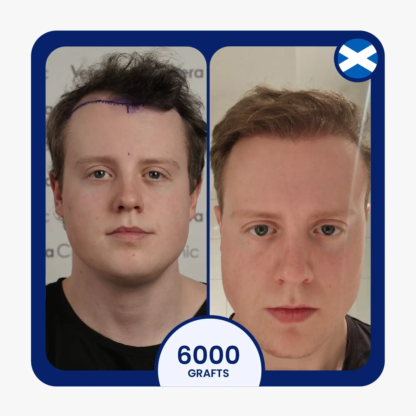 FUE hair transplant before after 6000 grafts blonde hair