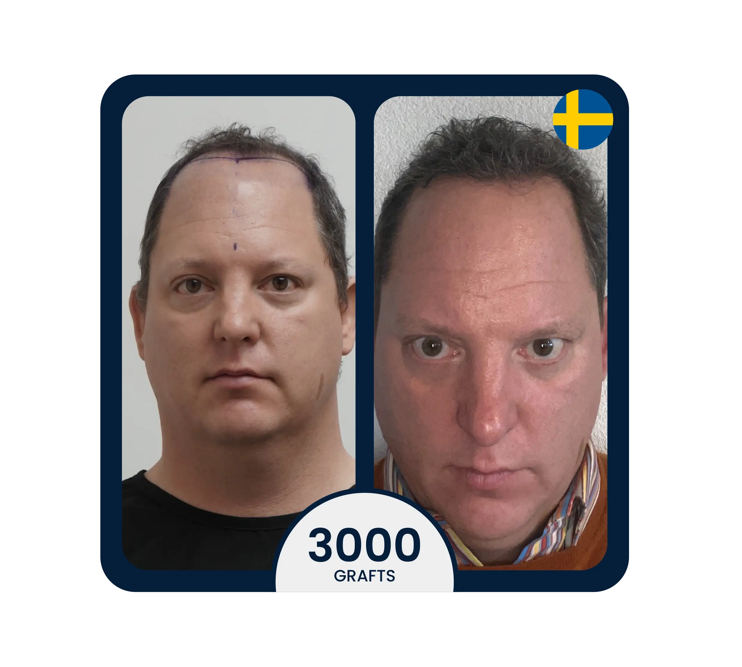 3000 graft hair transplant with stem cell hair growth result