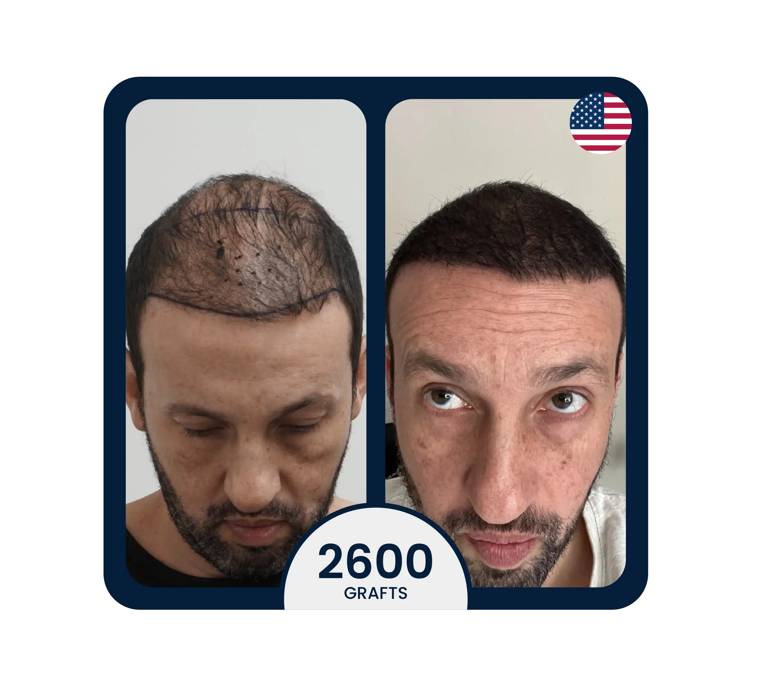stem cell hair transplant result for 2600 grafts