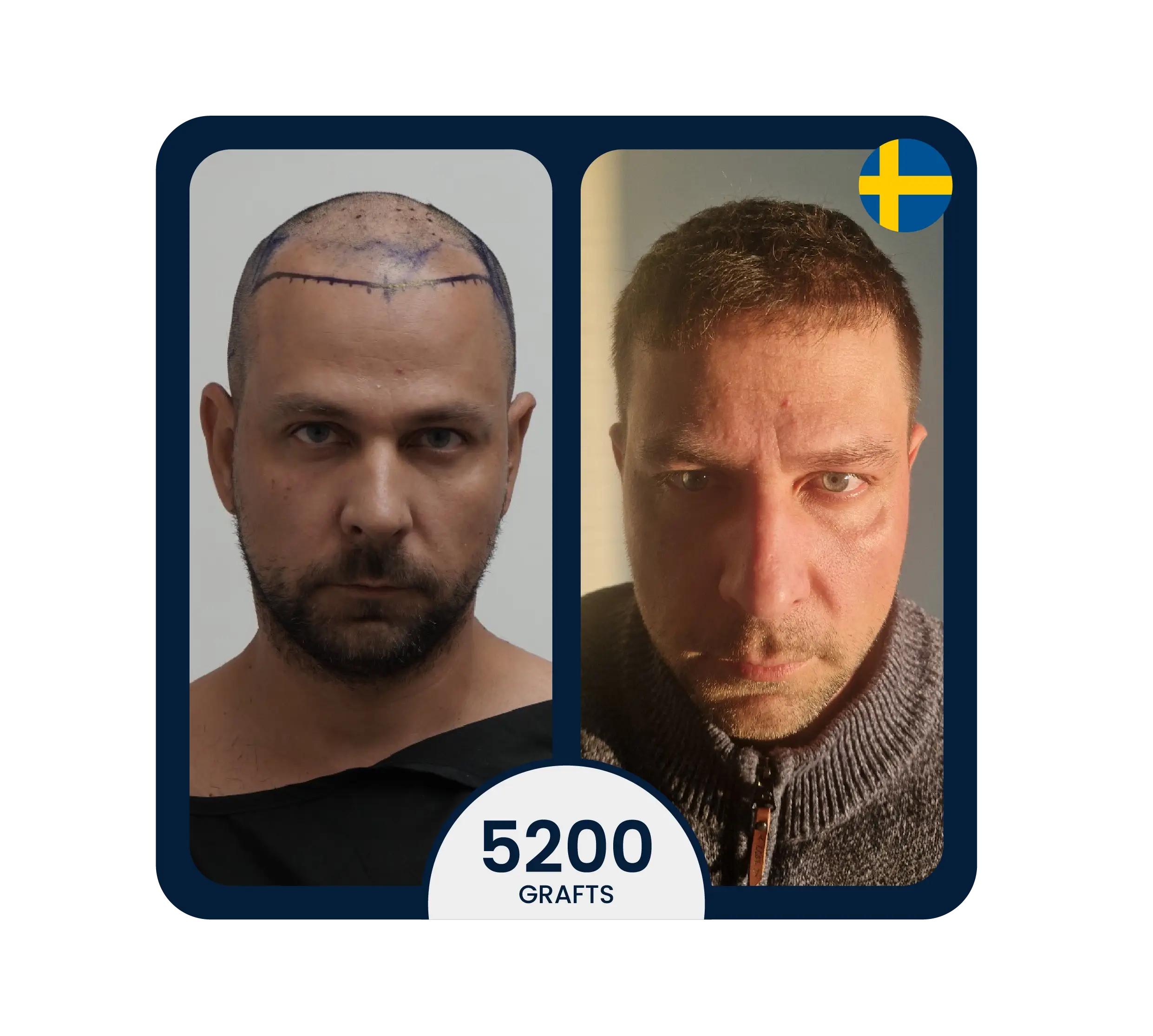 stem cell therapy supported hair transplant for 5200 light hair color