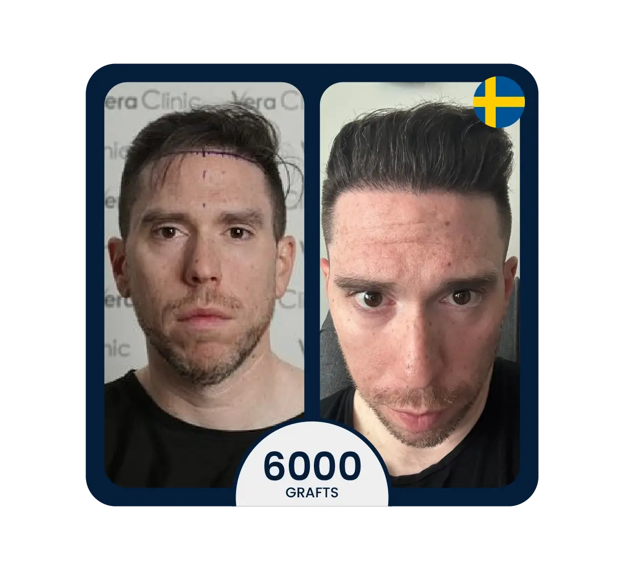 Sapphire FUE hair transplant before after 4900 grafts