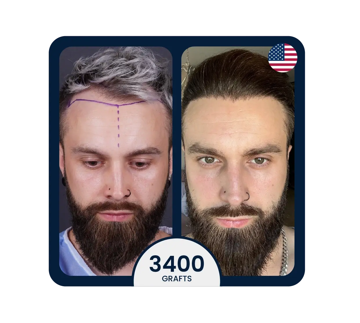 Sapphire FUE hair transplant before after 6000 grafts