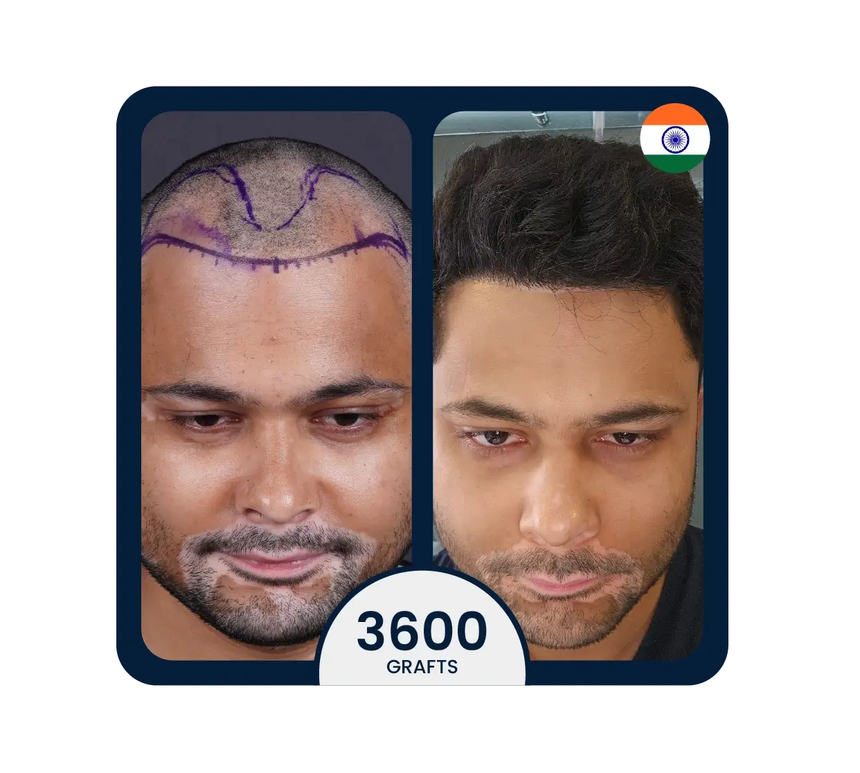 Sapphire FUE hair transplant before after 4100 grafts