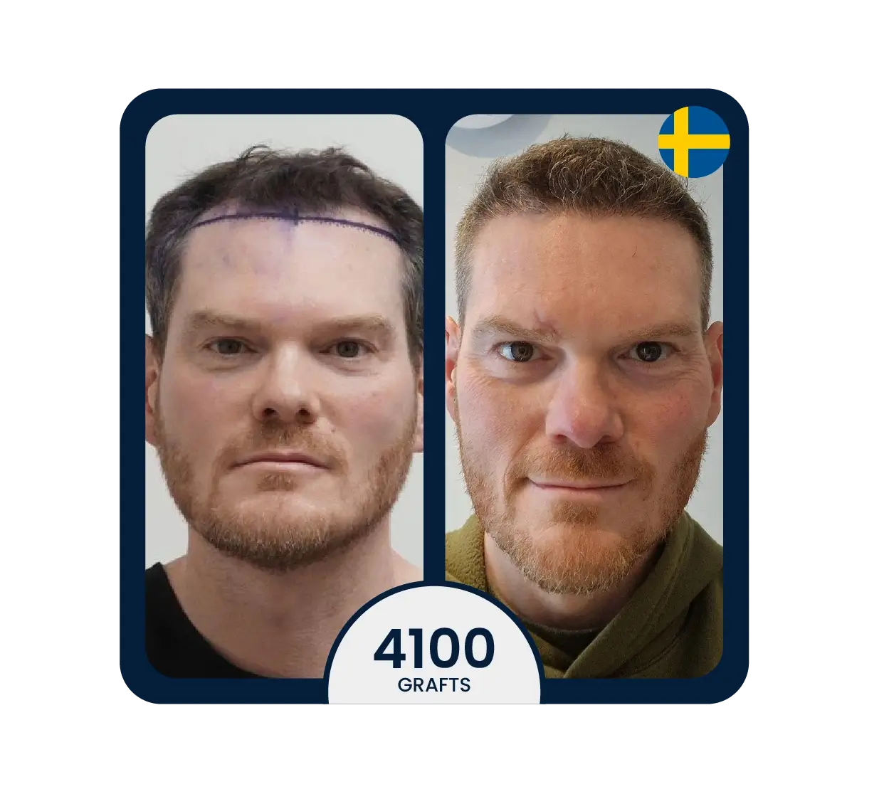 Sapphire FUE hair transplant before after 6200 grafts