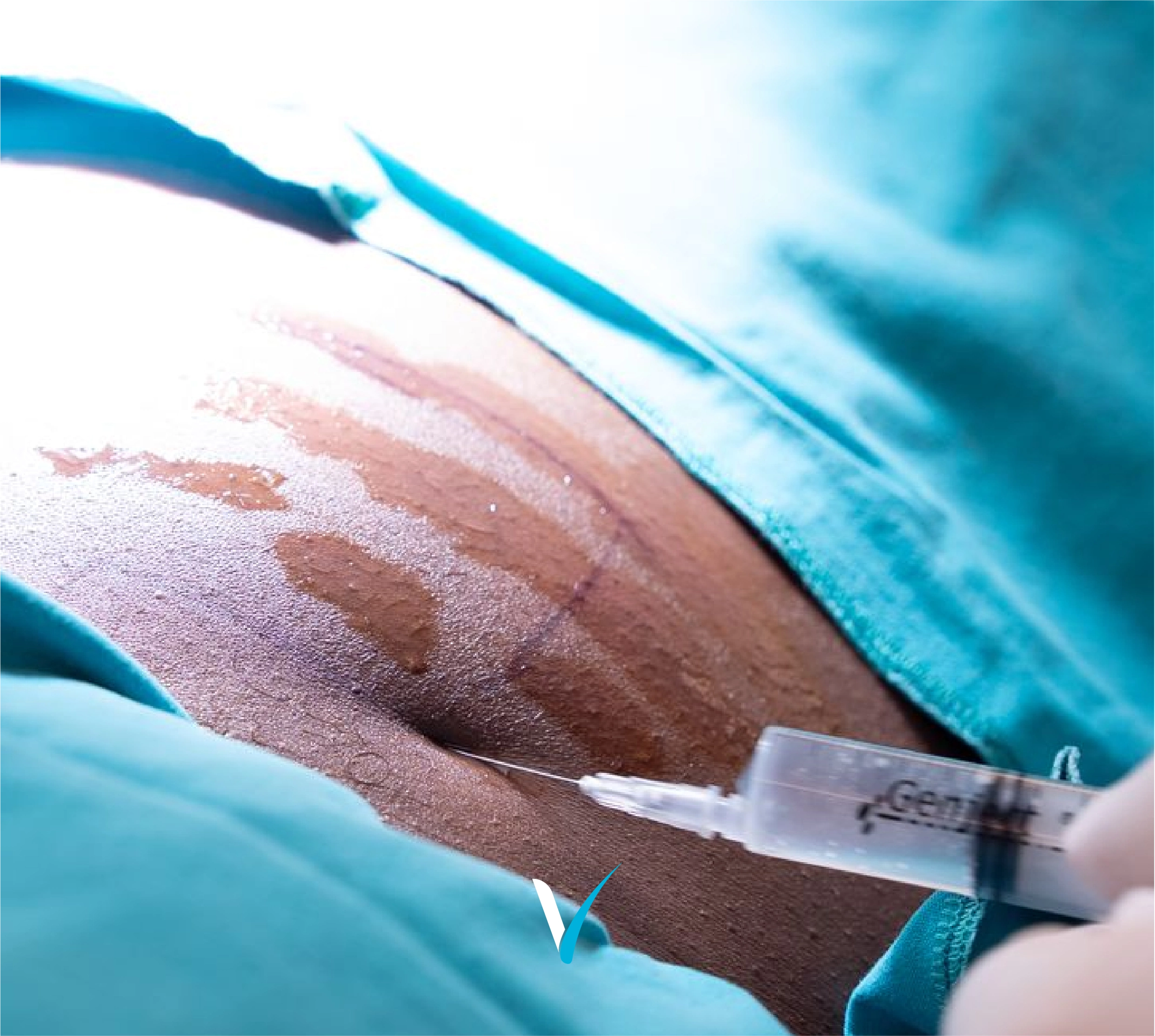 stem cell extraction from fat cells