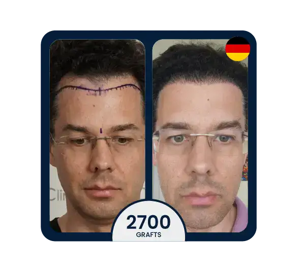 DHI hair transplant before after 2700 grafts