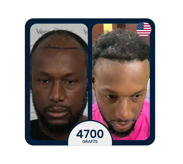DHI hair transplant before after 4700 grafts african-american results