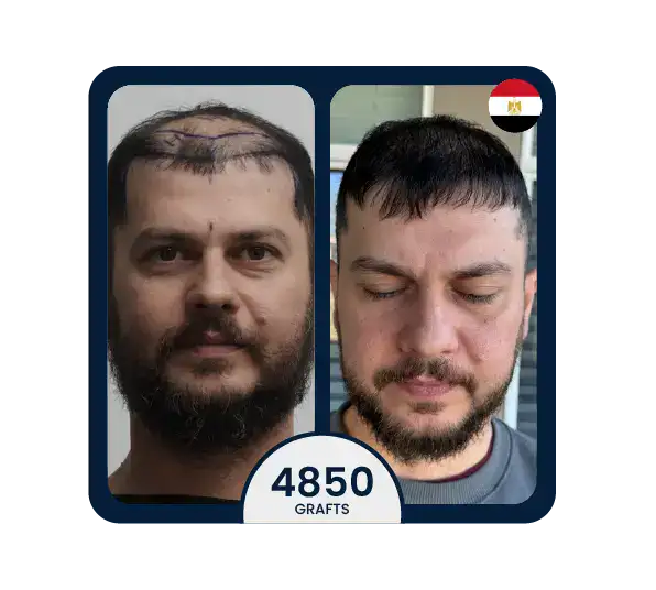 FUE hair transplant before after 4850 grafts
