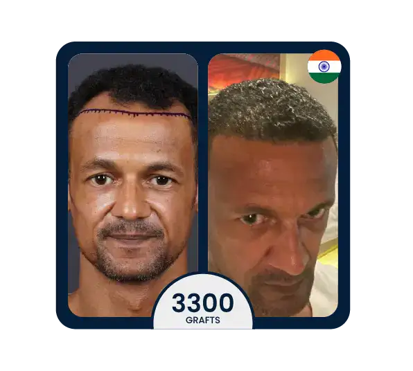 FUE hair transplant before after 3300 grafts