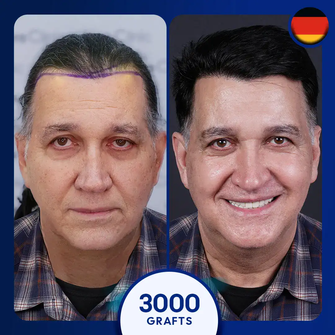 Greffe capillaire FUE avant et après