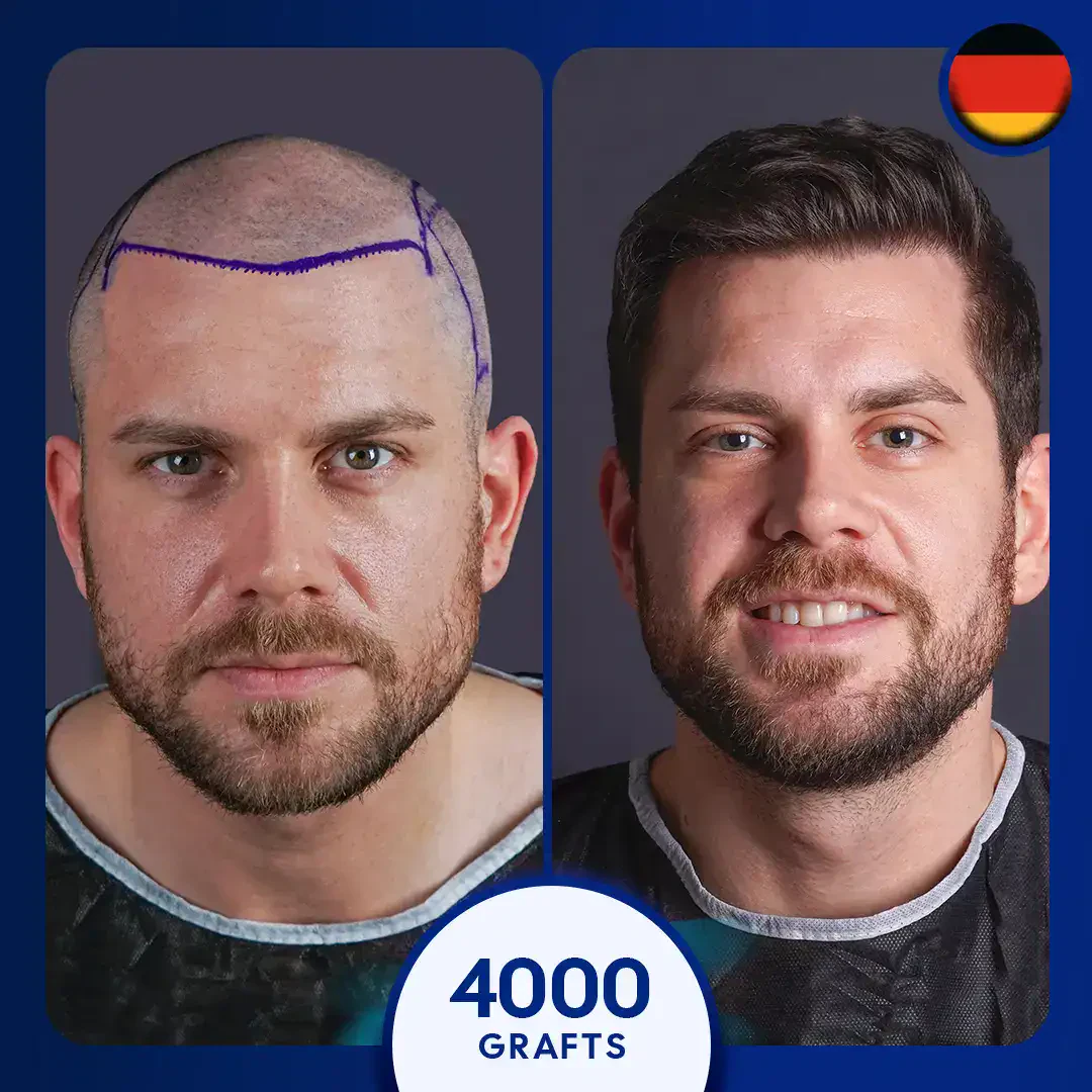 Greffe capillaire DHI avant et après