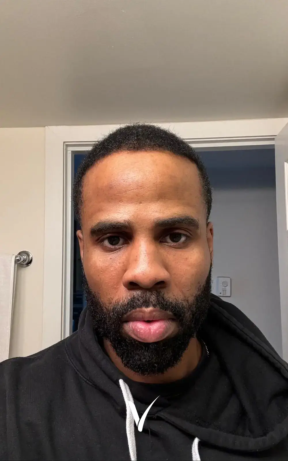 3000 grafts Afro hair transplant result with natural hairline and dense curls