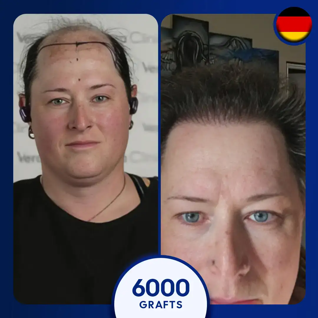 afro hair transplant for women, 6000 grafts