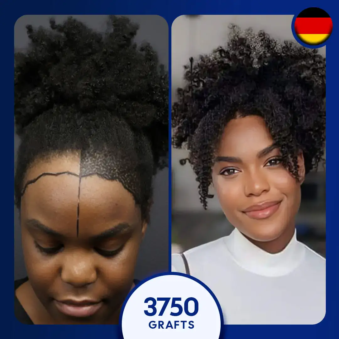 afro hair transplant for women, 3750 grafts
