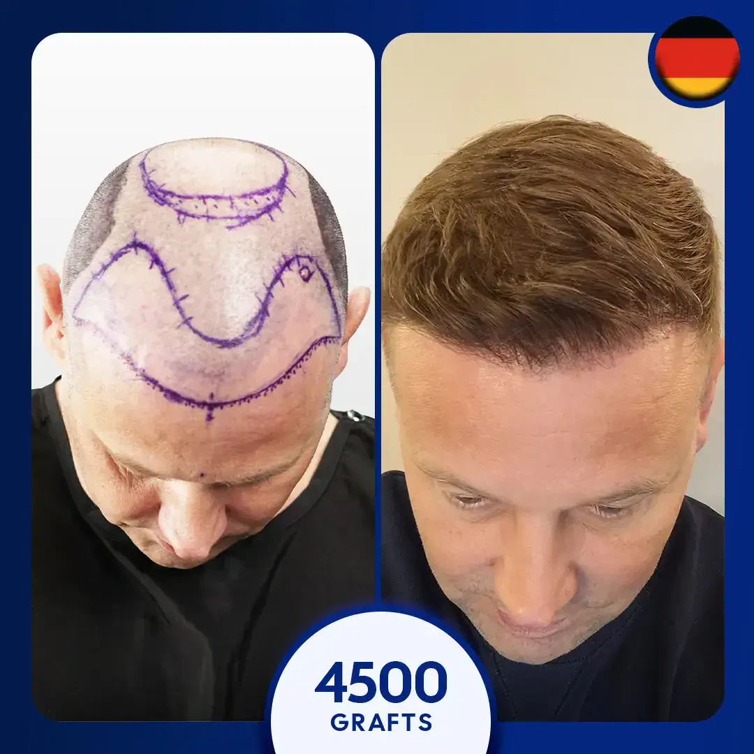 hair transplant turkey before and after