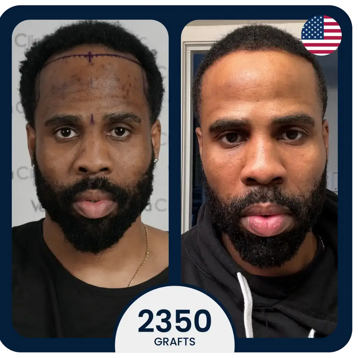 Black hair transplant before and after at vera clinic