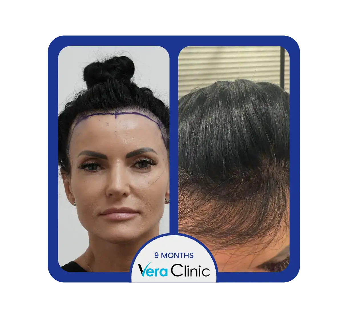 Haartransplantation bei Frauen vor und nach der Behandlung