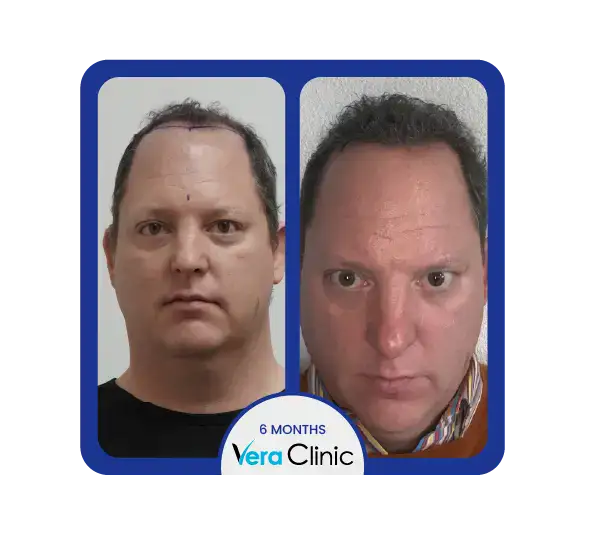 Bilder von 1000 Haartransplantaten mit Ergebnissen der Haartransplantation am Scheitel bei der Vera Clinic, die eine frühe Abdeckung und ein natürliches Wachstumsmuster zeigen.