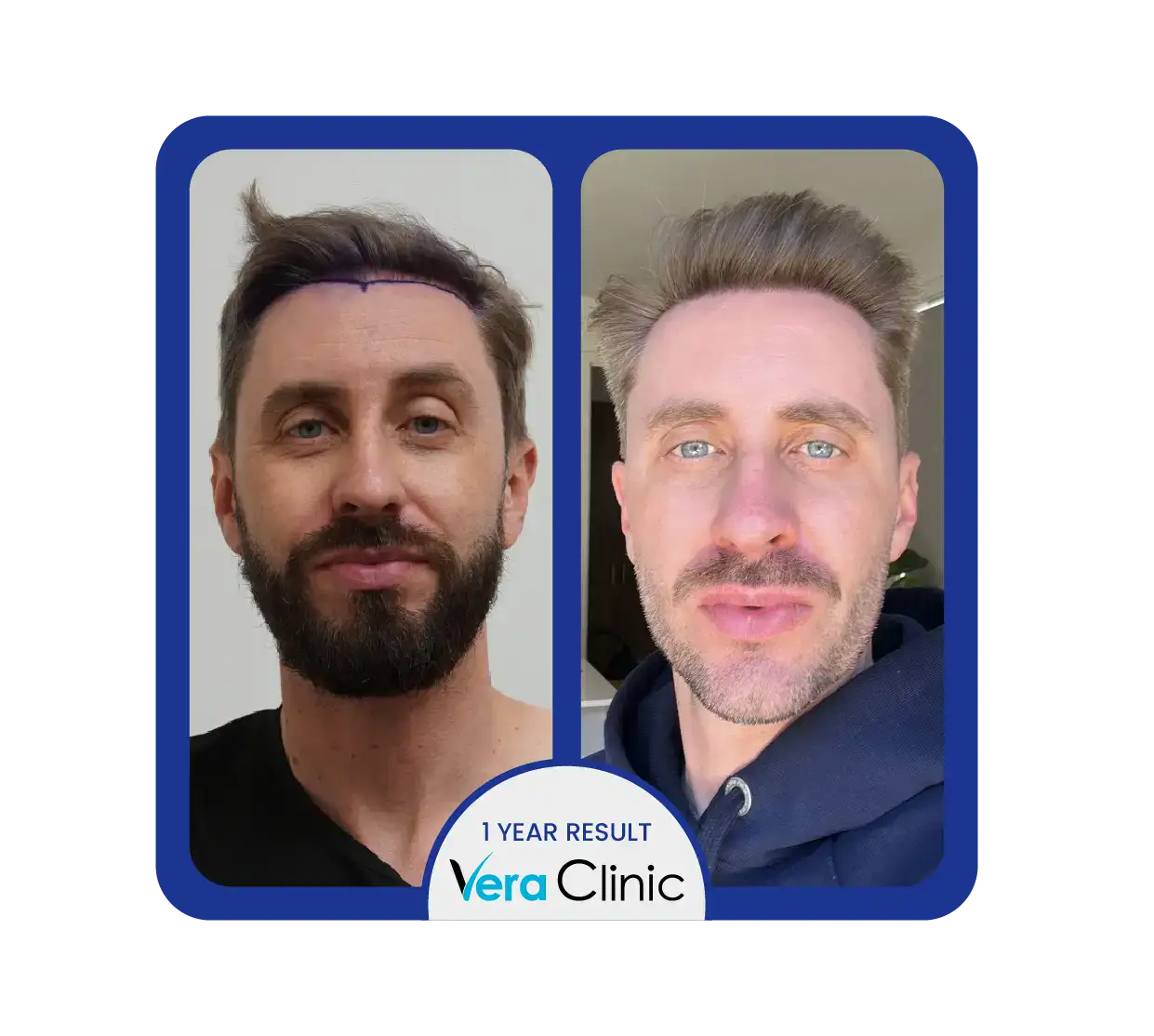 Ergebnisse einer Haartransplantation mit 1200 Transplantaten in der Vera Clinic in der Türkei, die eine verbesserte Dichte und ein verfeinertes Aussehen der Haarlinie zeigen.